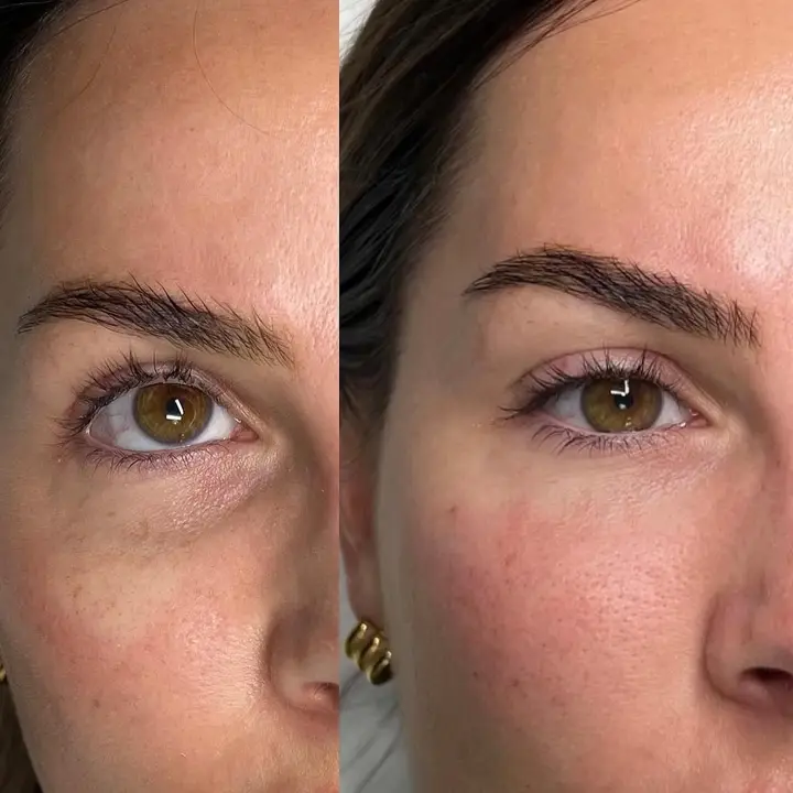 For under-eye darkness and hollowness, every case is different and requires…