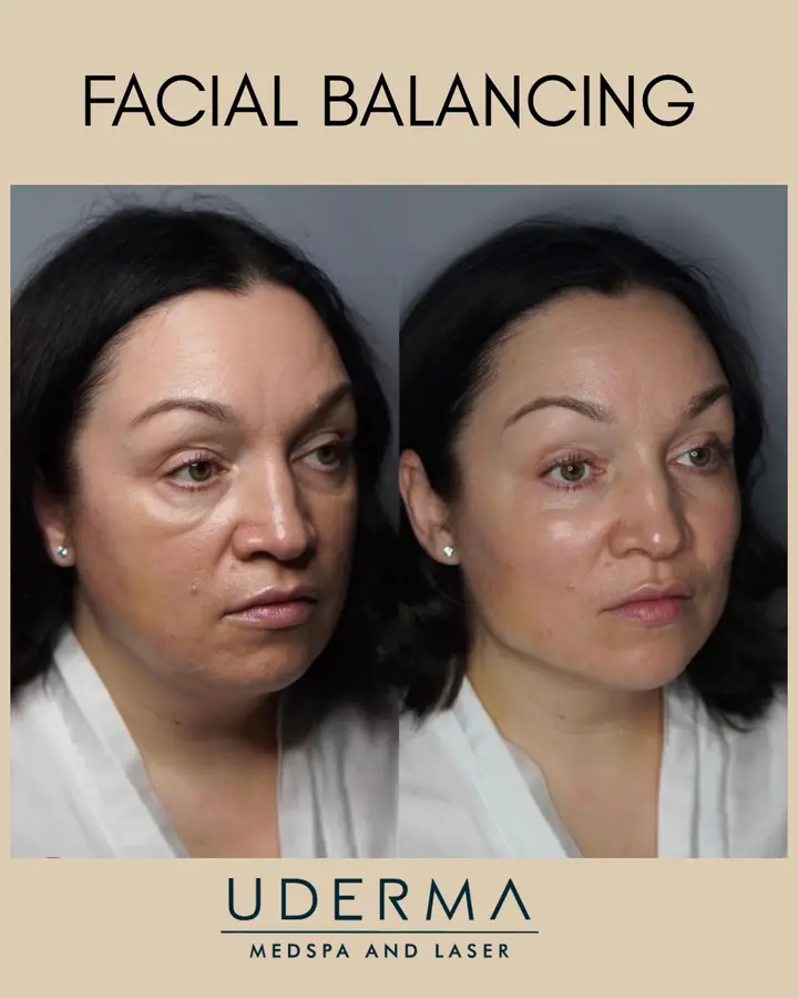 Beautiful example of how facial balancing can create a younger, more lifted…