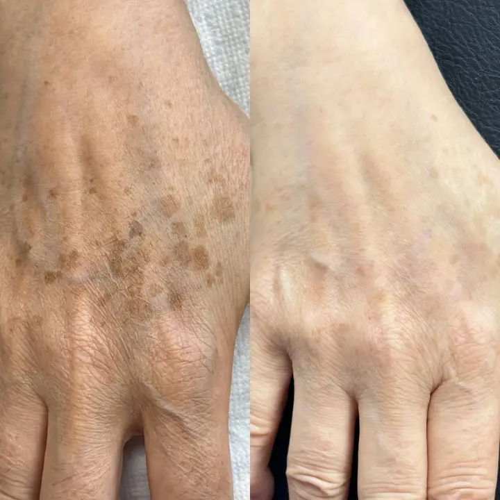 BBL + MOXI is an amazing combination for almost any age, helping to improve