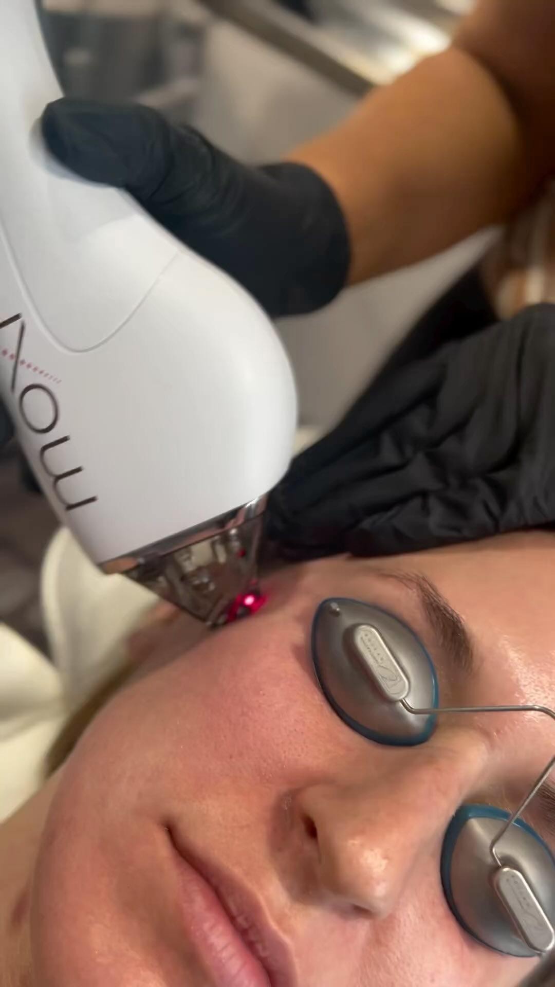 MOXI is a gentle laser which resurfaces skin to help lighten, brighten and refresh your skin with mi