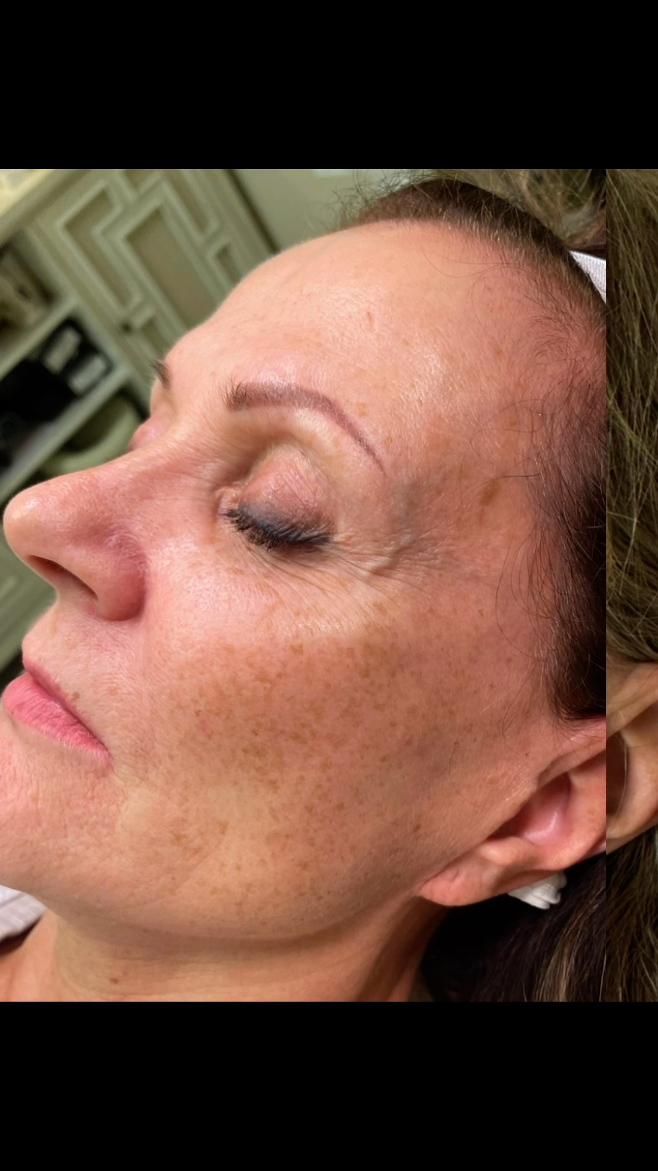 The combination therapy of MOXI and BBL is an unbeatable treatment pairing for total facial skin ren