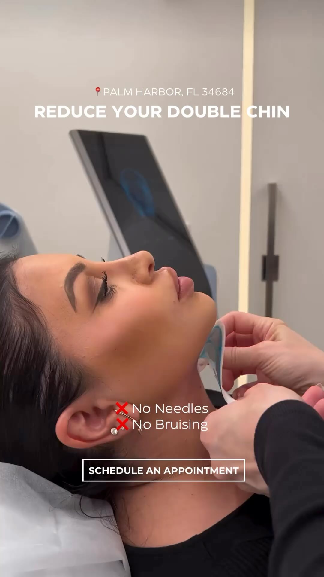 EMFACE Submentum is a non-invasive, double-chin removal that targets both the deep muscles and fat i