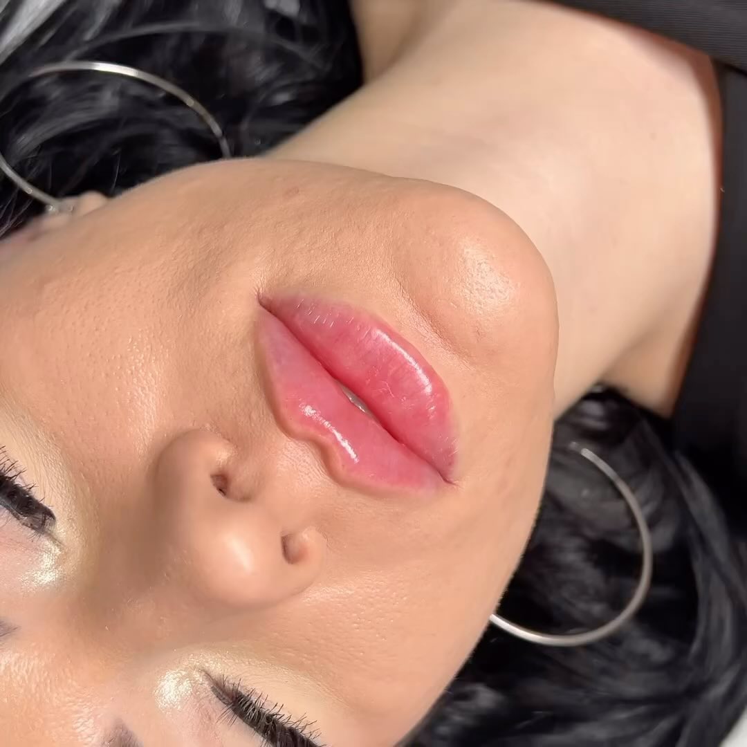 RHA lip filler offers a revolutionary approach to lip enhancement, providing natural-looking results