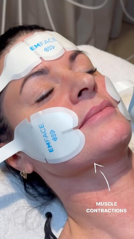 EMFACE is the needle-free procedure that reduces wrinkles and provides more lift. EMFACE is the firs