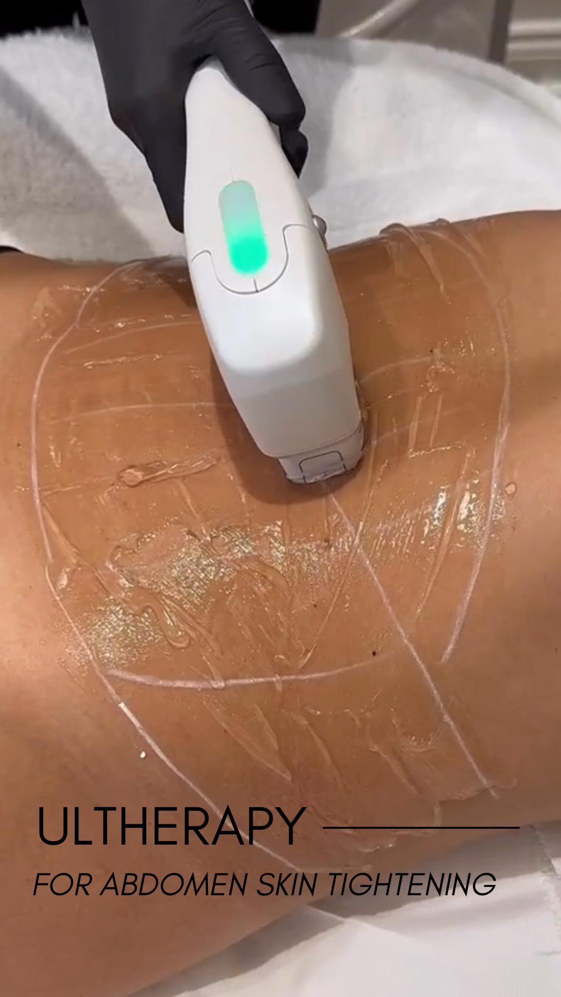 Ultherapy is a popular non-invasive skin tightening and lifting treatment often used for areas like 