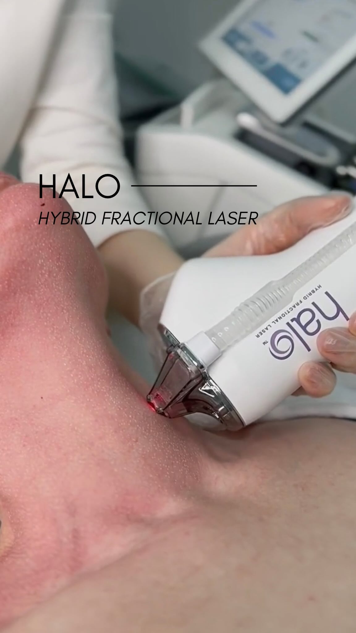 The Halo laser is a hybrid fractional laser treatment that combines both ablative and non-ablative w