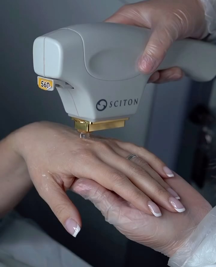 BBL HERO effectively addresses a variety of skin concerns using advanced BroadBand Light technology.