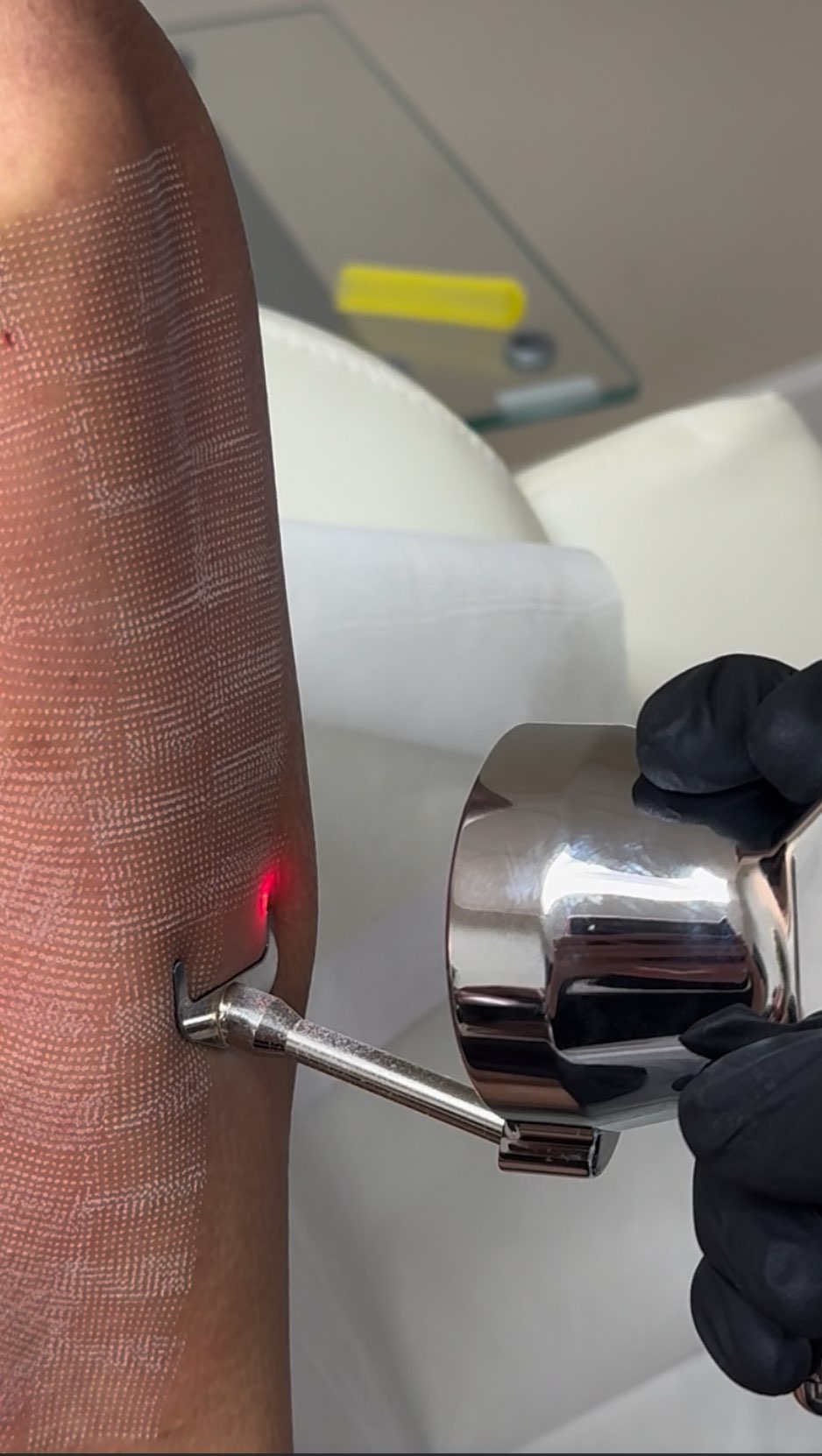 Erbium Sciton Laser Skin Tightening is a cosmetic procedure that uses an erbium laser to rejuvenate 