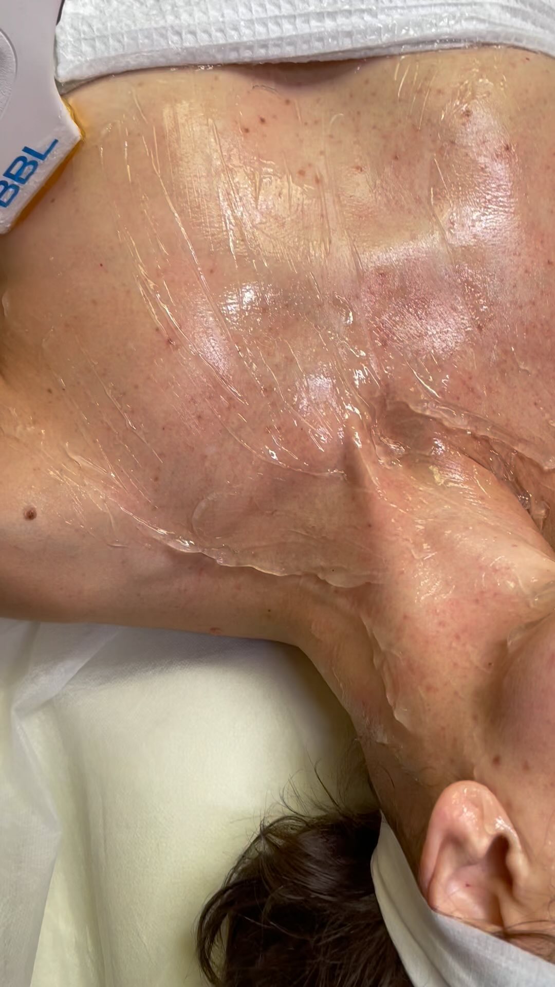 ✨BYE BYE SUMMER SUN DAMAGE! 🌟 Whether it’s your chest, face, neck, or full body, this revolutionary