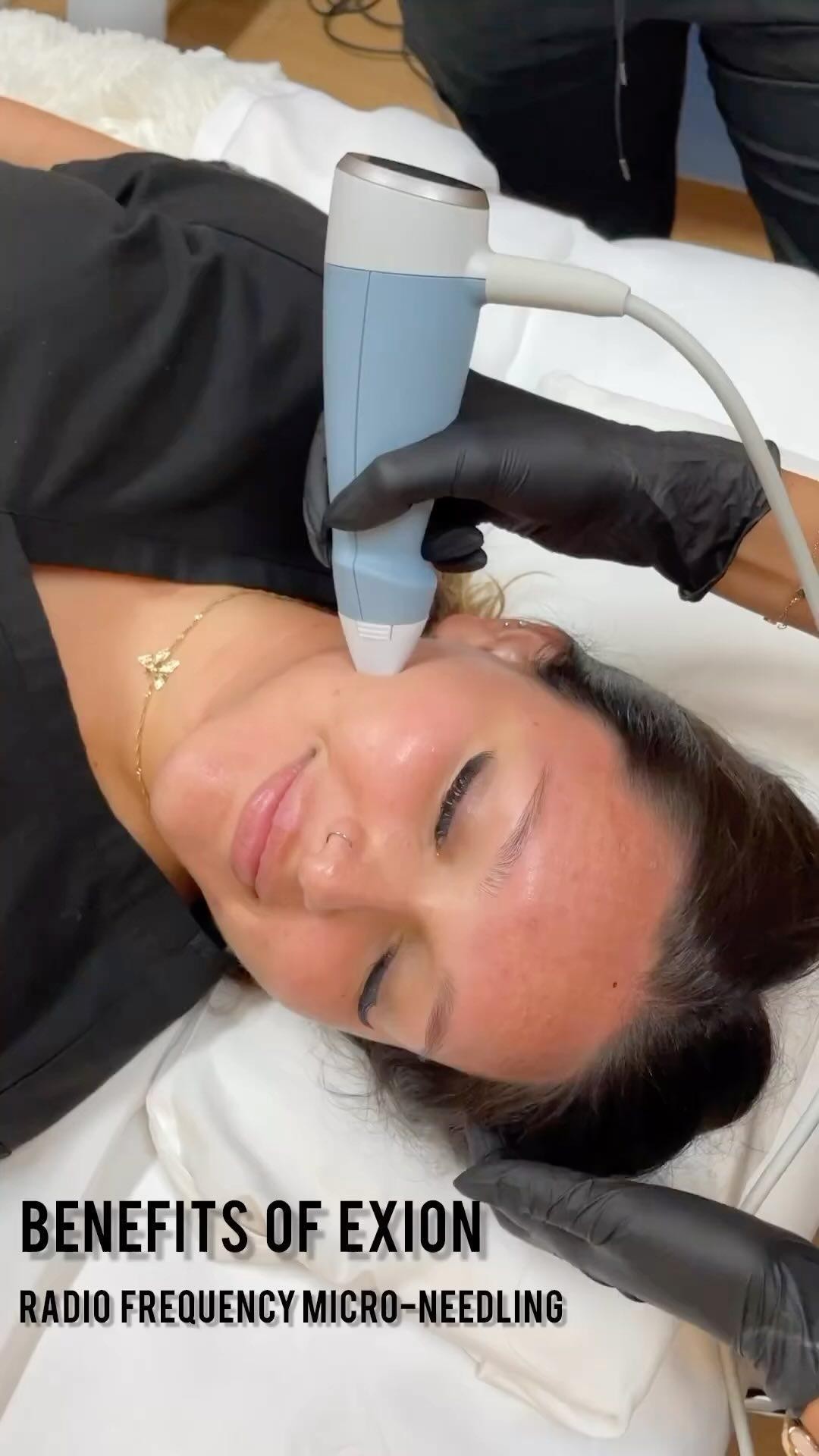 Exion has all the benefits of Targeted Ultrasound Energy combined with Fractional RF Microneedling f