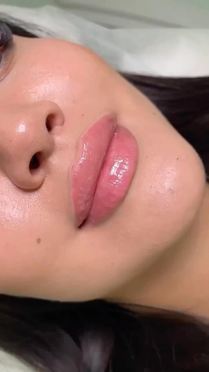 We decided to extend our AMAZING $650 Lip Filler Promo (reg $750) 🌟🌟🌟