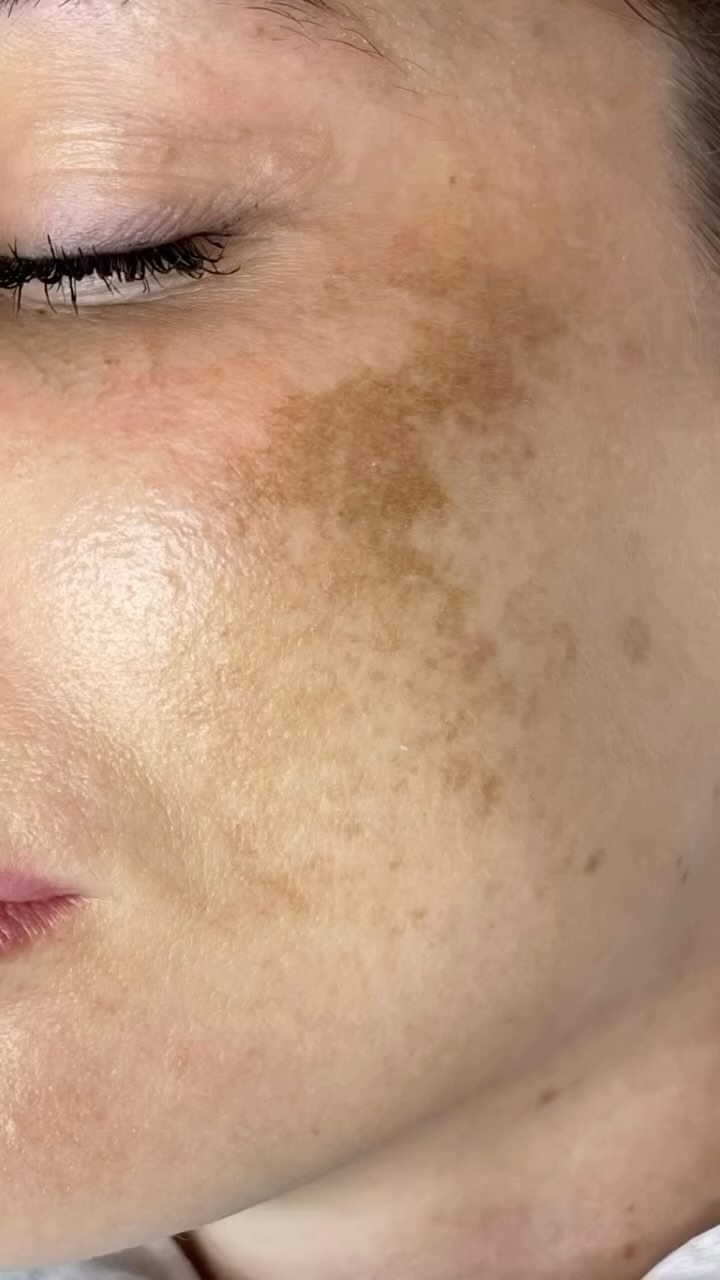 We are offering a comprehensive treatment for melasma that combines BBL (BroadBand Light) therapy, M