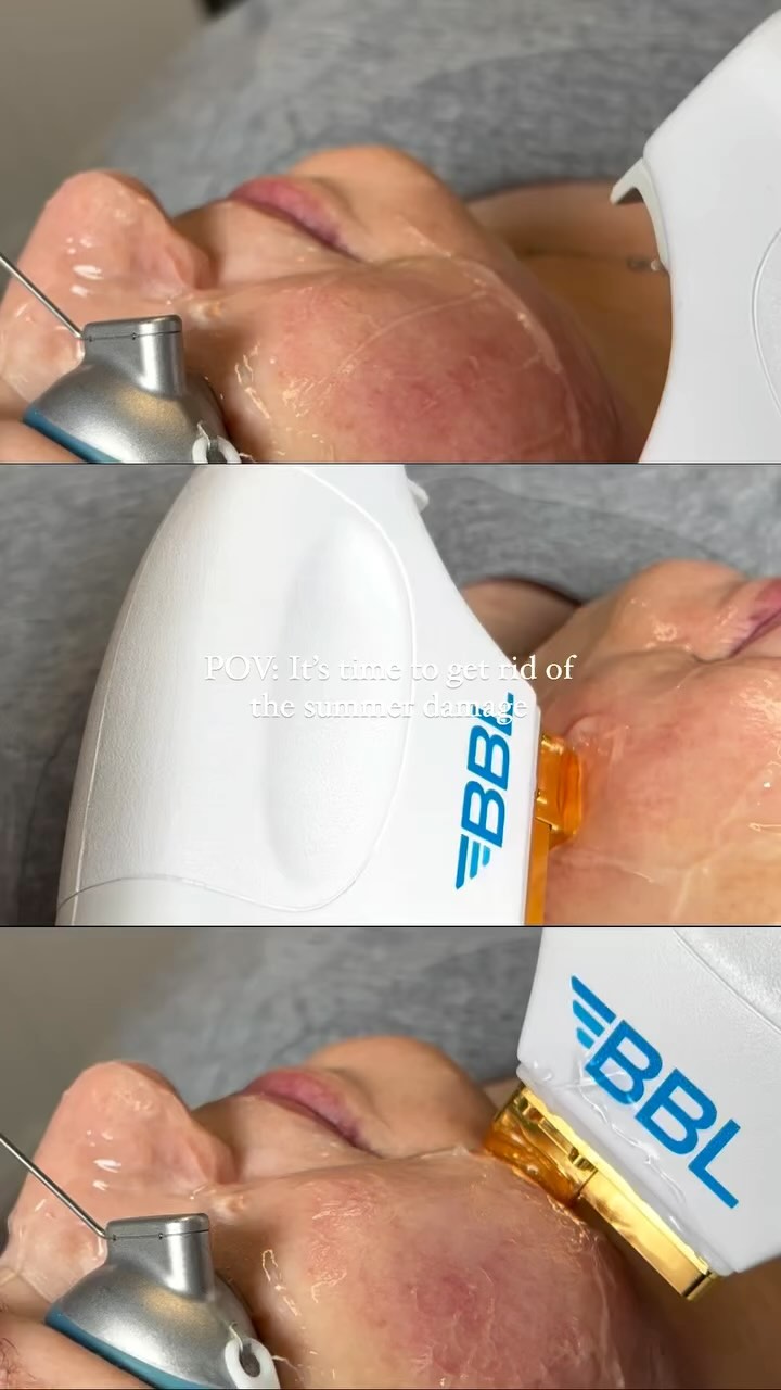 ✨ Reveal Your Best Skin with BBL HERO! ✨
