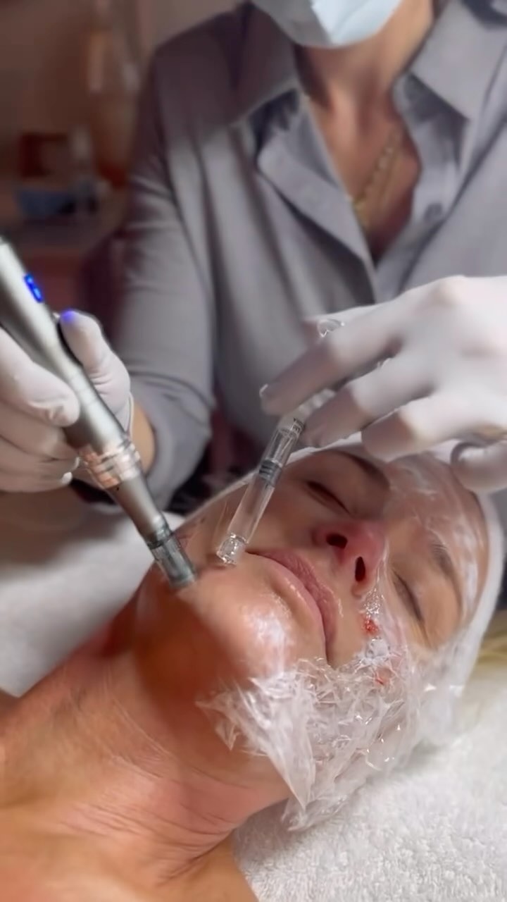Exosome Microneedling: A Cutting-Edge Skin Rejuvenation Treatment