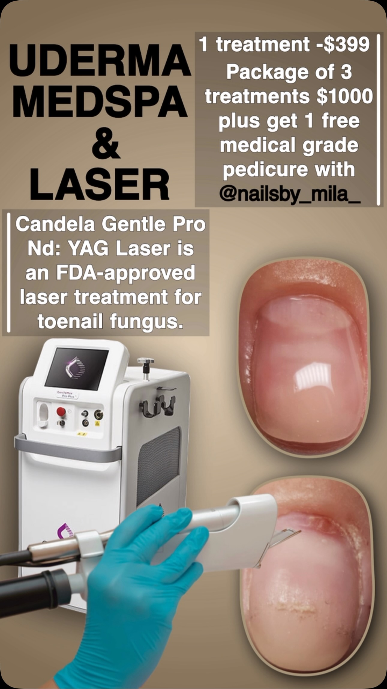 Say Goodbye to Toenail Fungus with Candela Gentle Pro Nd:YAG Laser! 👣✨#LaserTherapy #CandelaGentleP