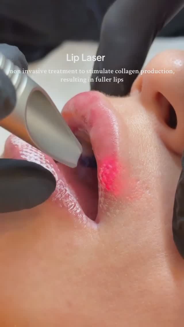 💋 Smooth, Soft, and Youthful Lips with Laser Rejuvenation