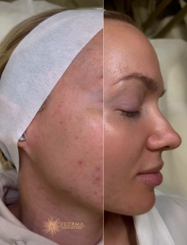 ✨ Reveal Your Glow with BBL + Moxi ✨