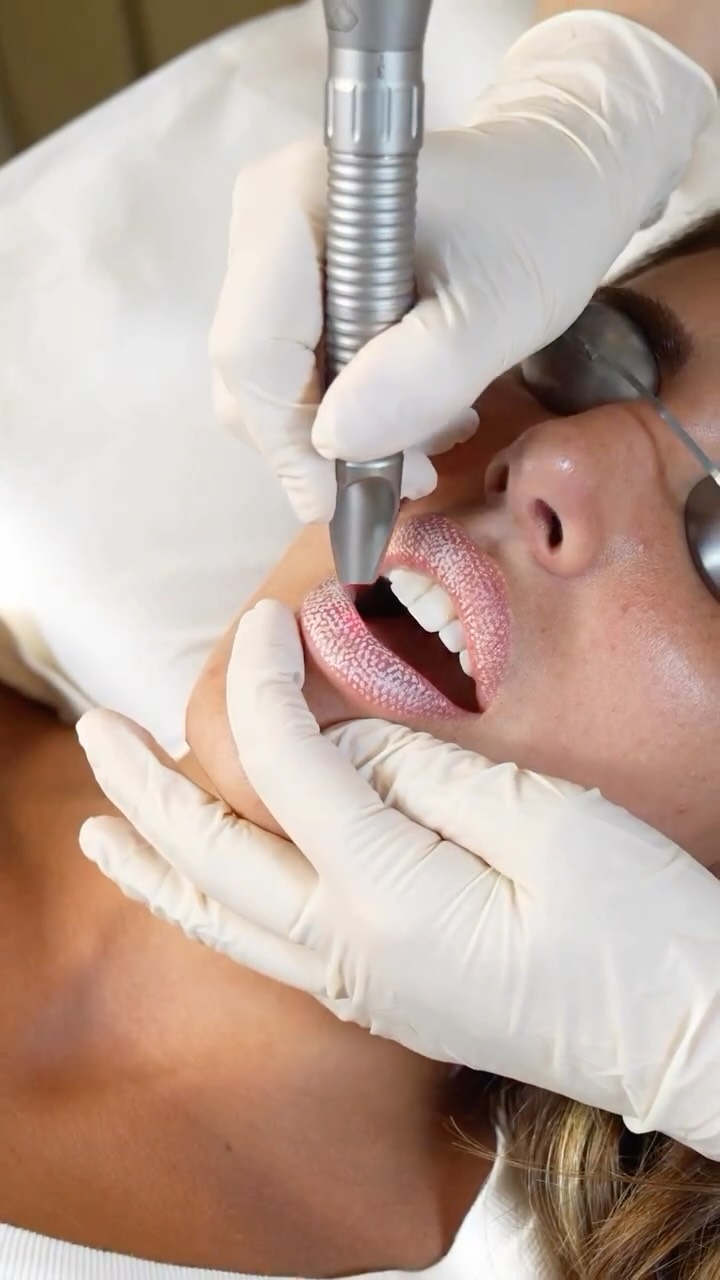 💋 LipLase™ Treatment 💋