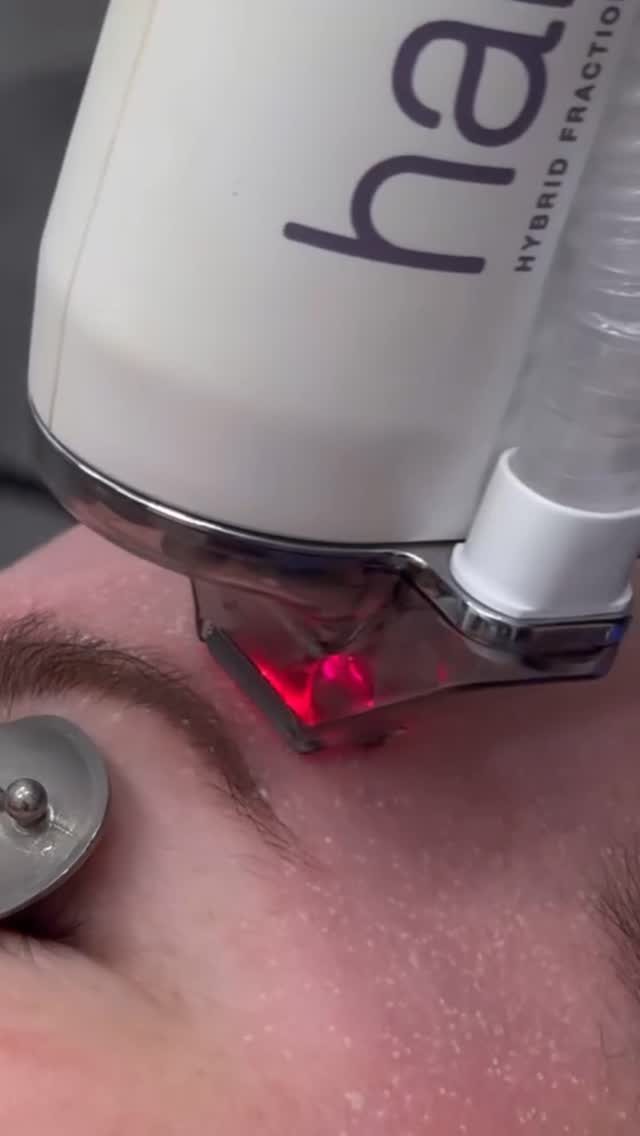 We’re obsessed with Halo Laser results—and our clients are too!