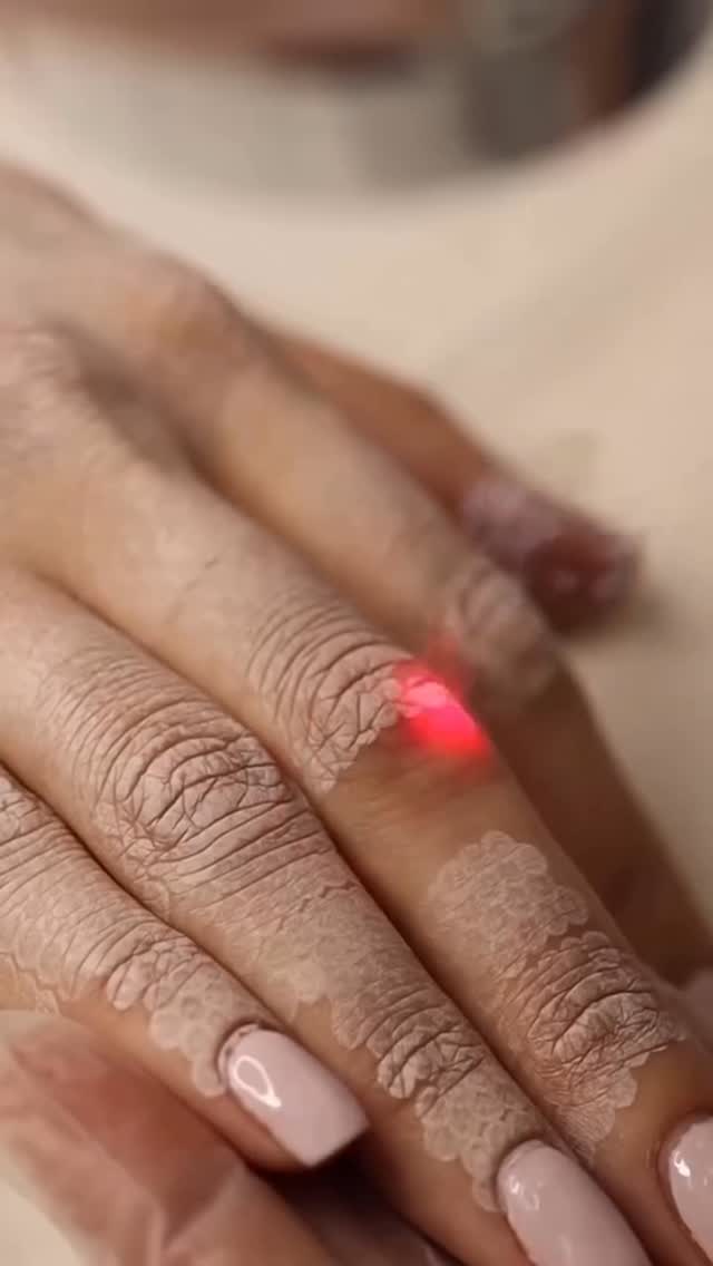 Light Erbium laser resurfacing for hands, face, neck, or chest.