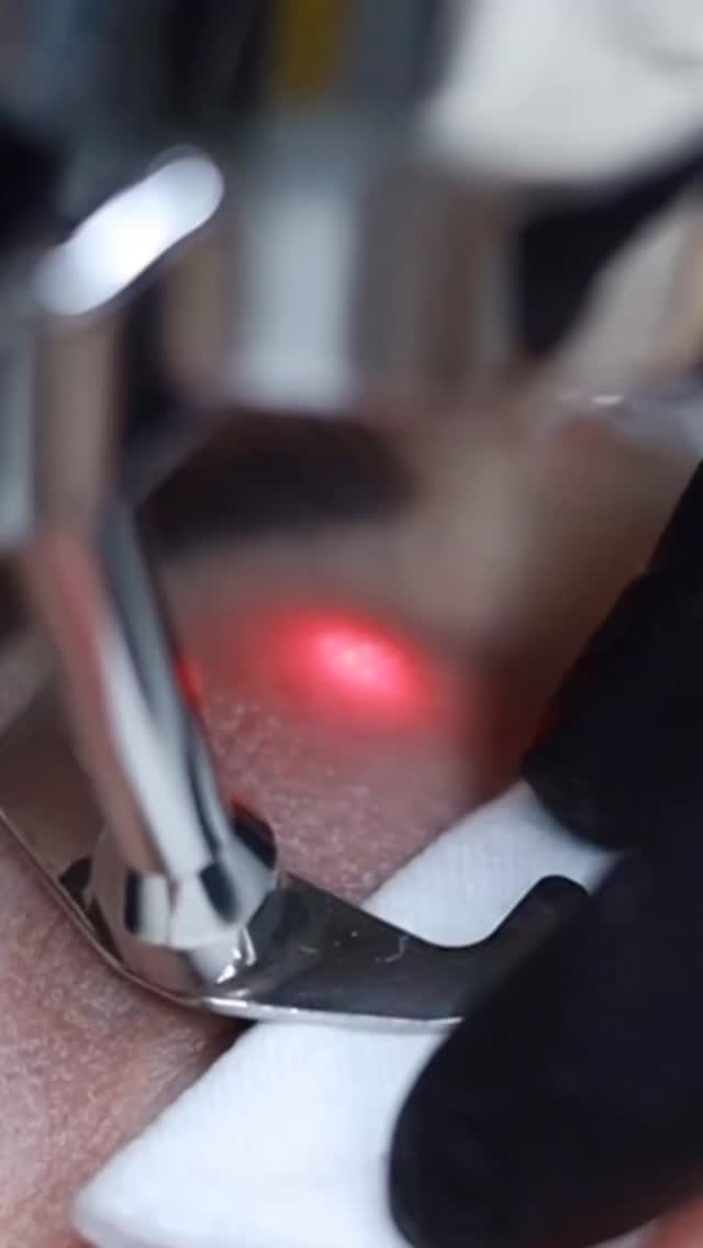 ProFractional Erbium Laser — Your Skin’s Collagen-Boosting Power Treatment ✨