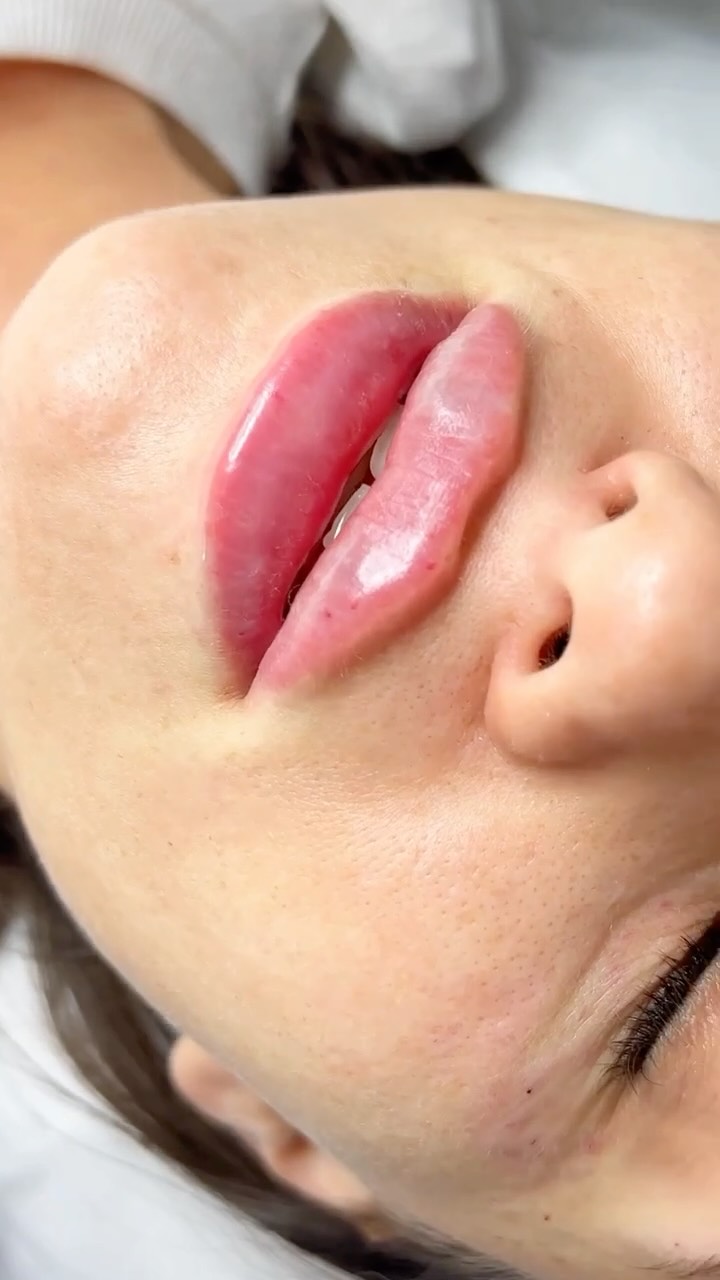 LIP FILLER — Enhance Your Anatomy, Not Change It ✨