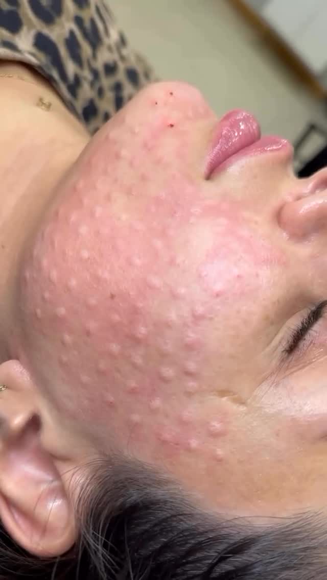 Not all skin treatments are about filling or tightening.