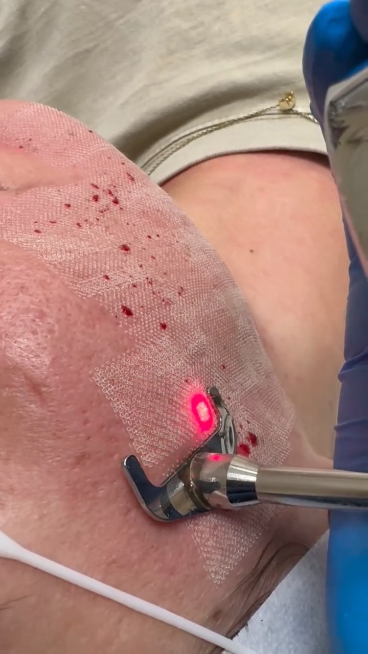 ProFractional Laser is an advanced ablative resurfacing treatment that creates controlled micro-chan