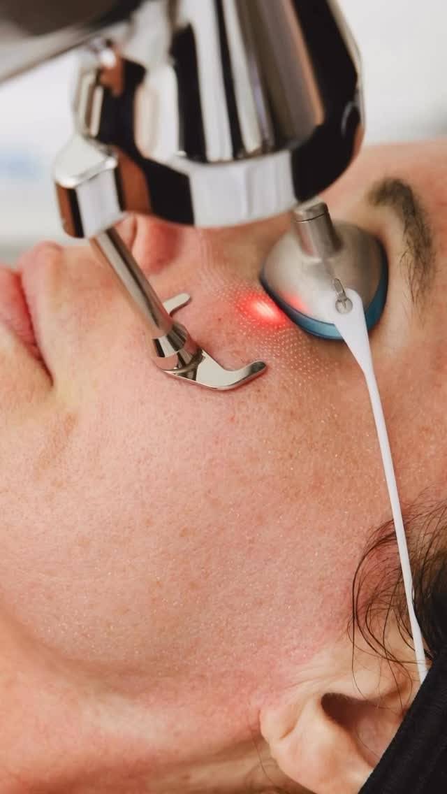 ProFractional laser is similar to CO₂ — but better (for most patients). Why?
