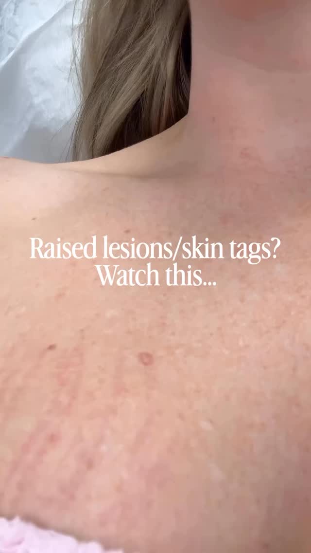 Raised lesions or skin tags?