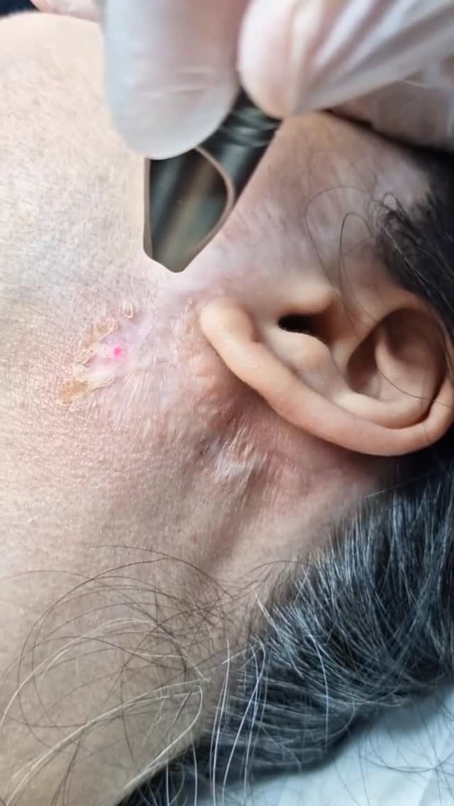 Plastic Surgery Scars? We Can Help.