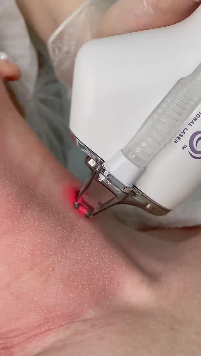 ✨ HALO® LASER RESURFACING ✨