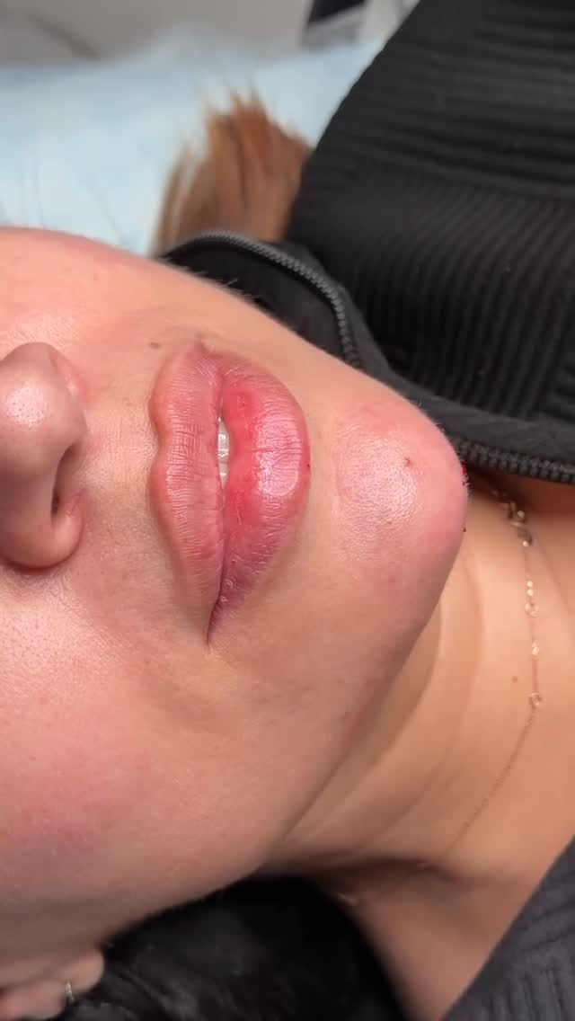 LIP + CHIN FILLER = THE PERFECT BALANCE ✨