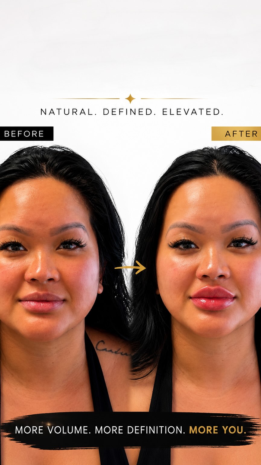 RUSSIAN TECHNIQUE LIP FILLER