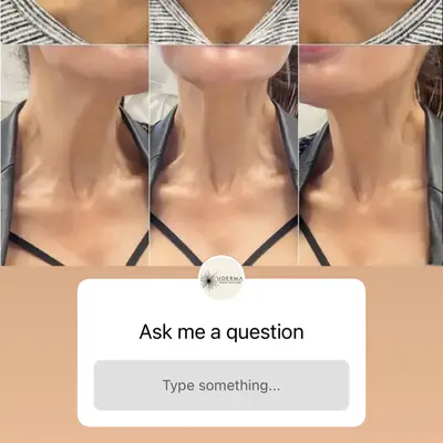 NEFERTITI LIFT WITH BOTOX